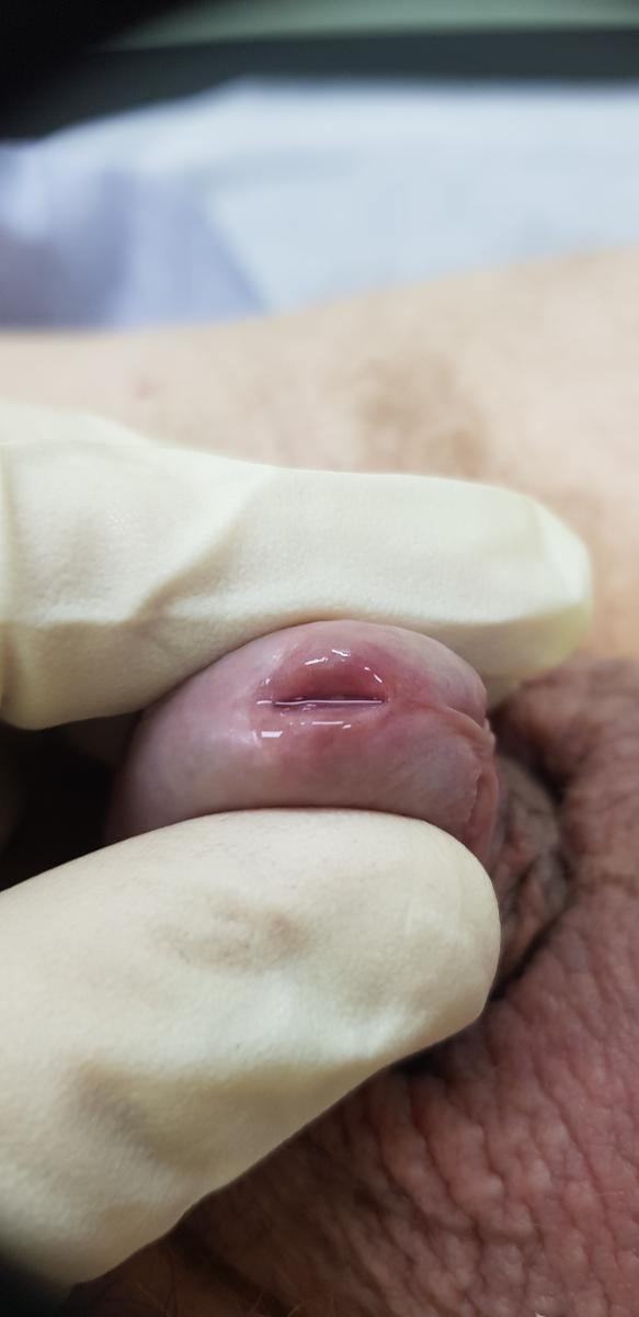 Патологические выделения Гнойные выделения из уретры