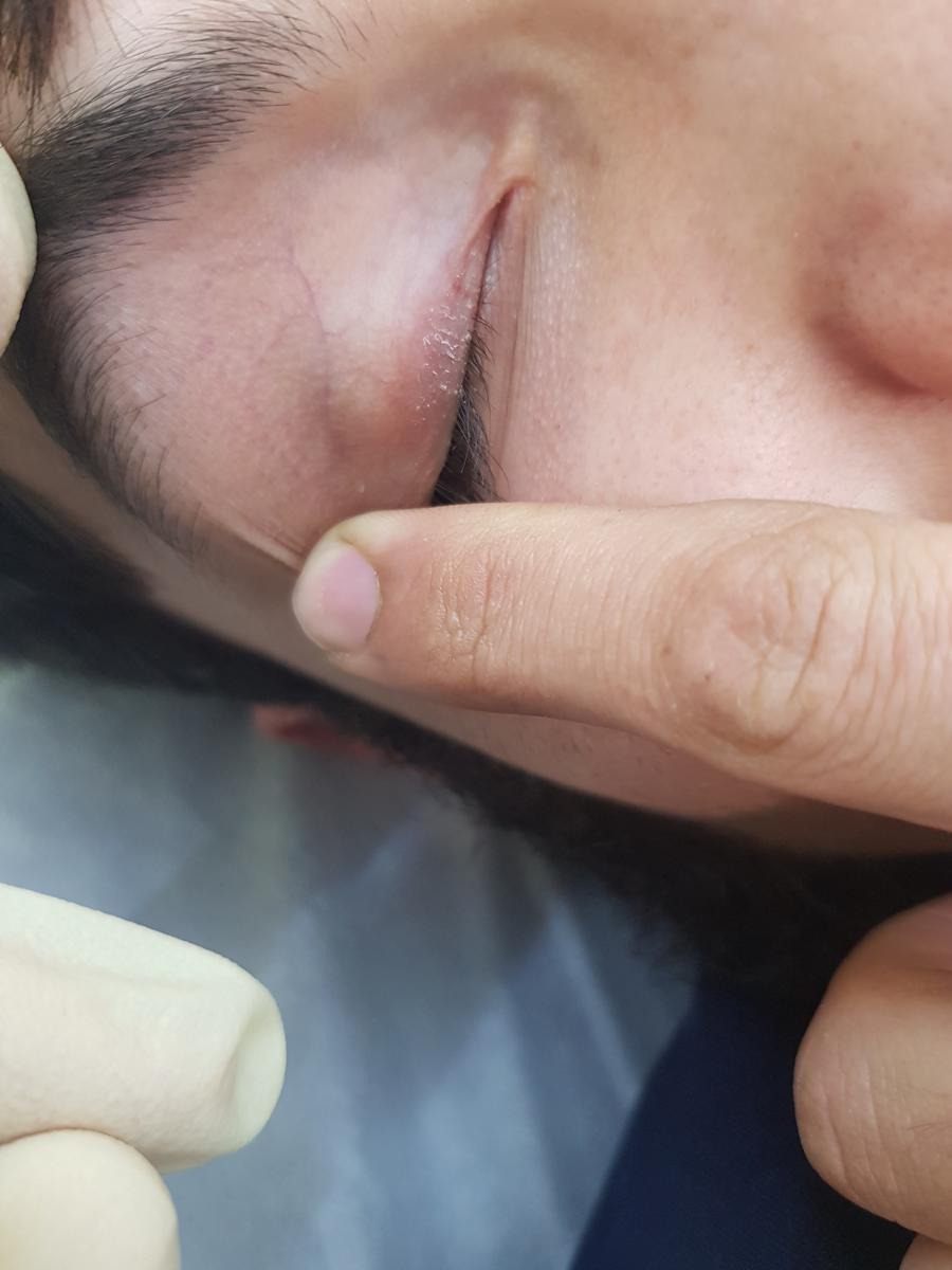 хламидийный коньюктивит коньюктивит