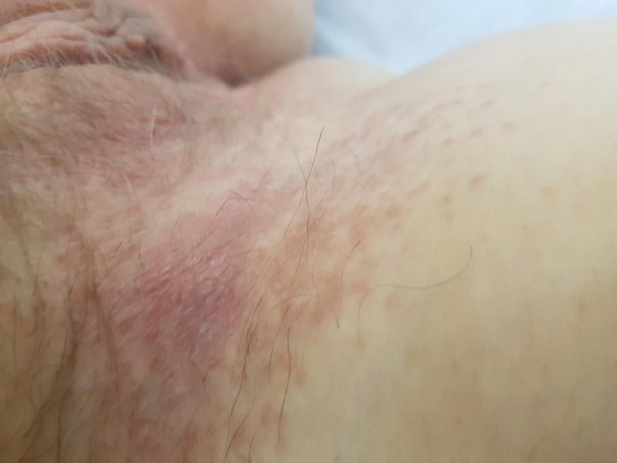 покраснение в паховой складке при опрелости у мужчин