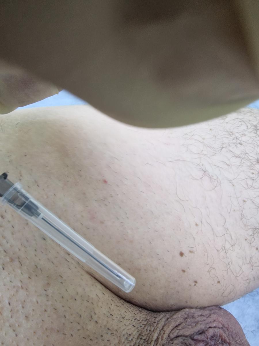 лимфотропная терапия лимфо