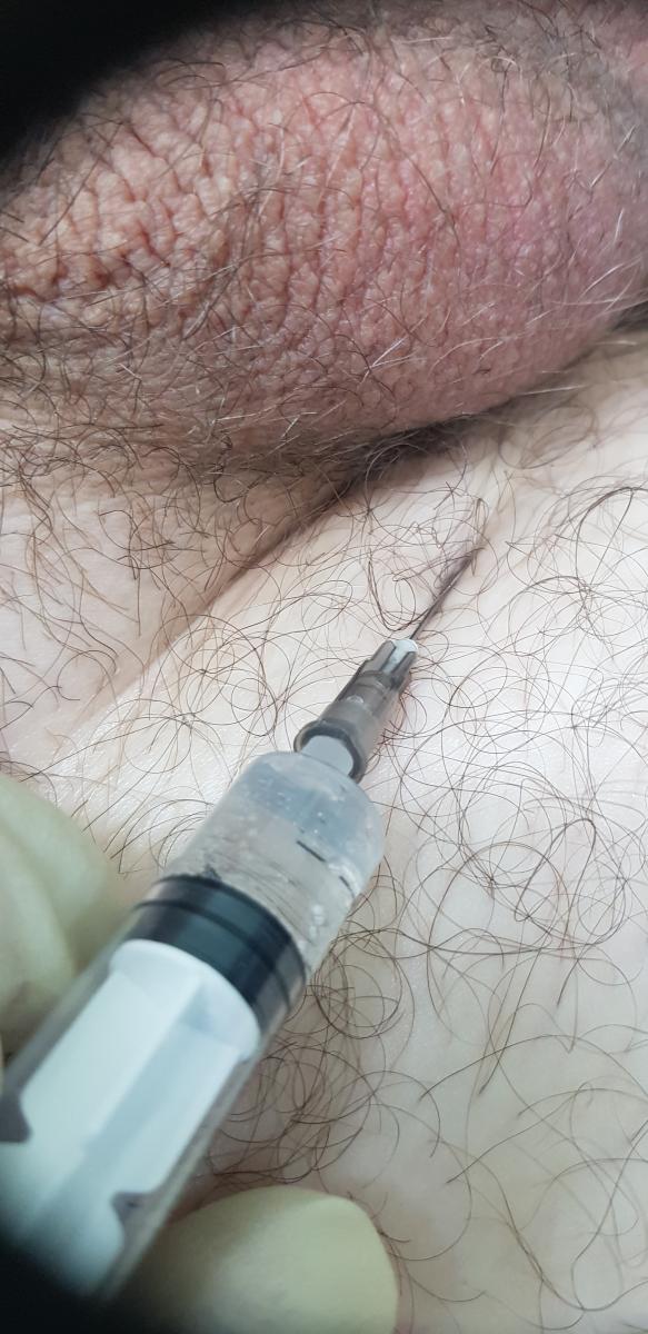 лимфотропное введение антибиотиков или лонгидазы лимфотропка