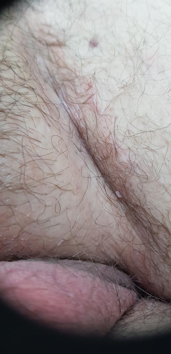 опрелость в паху