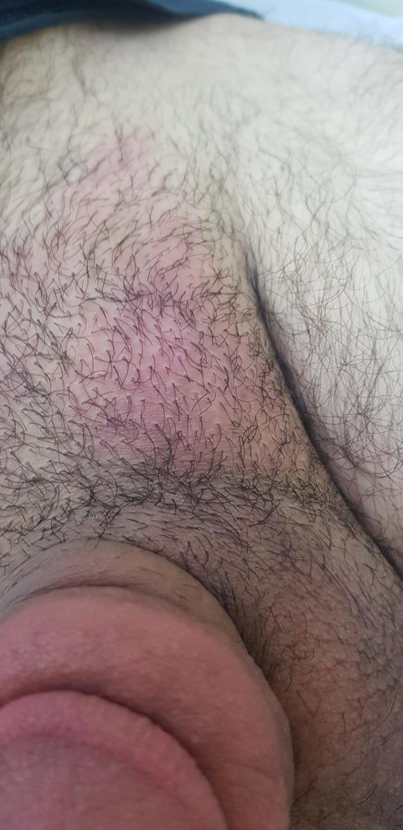 Подчелюстной лимфаденит Воспаление подчелюстного лимфоузла при сифилисе