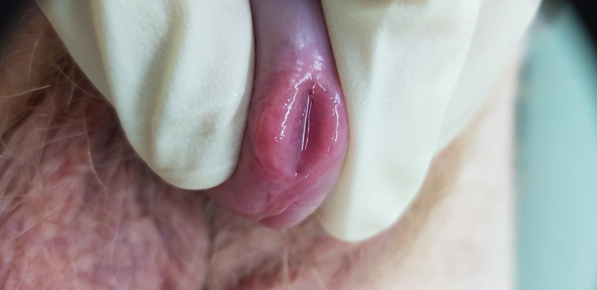 Неспецифический уретрит