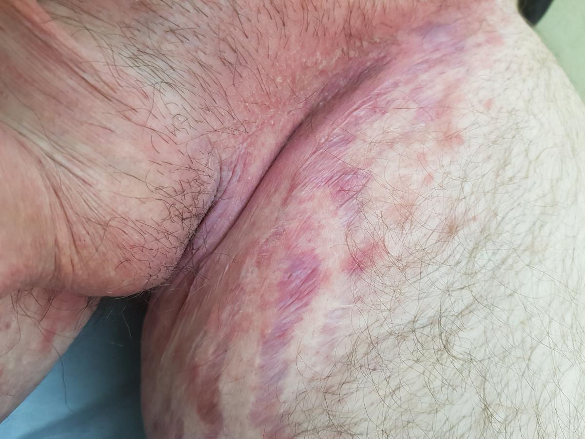 крем клотримазол 