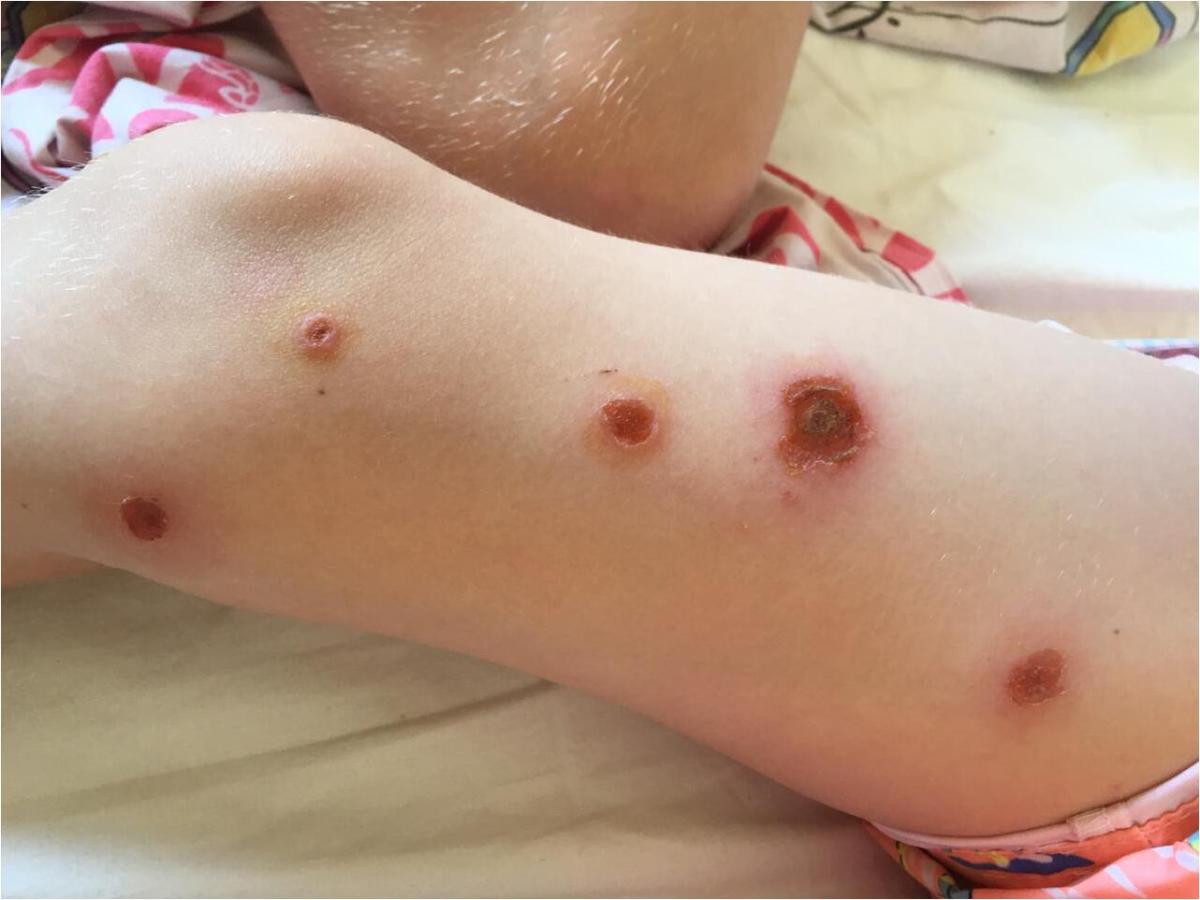 Язвы на теле Язвы на теле