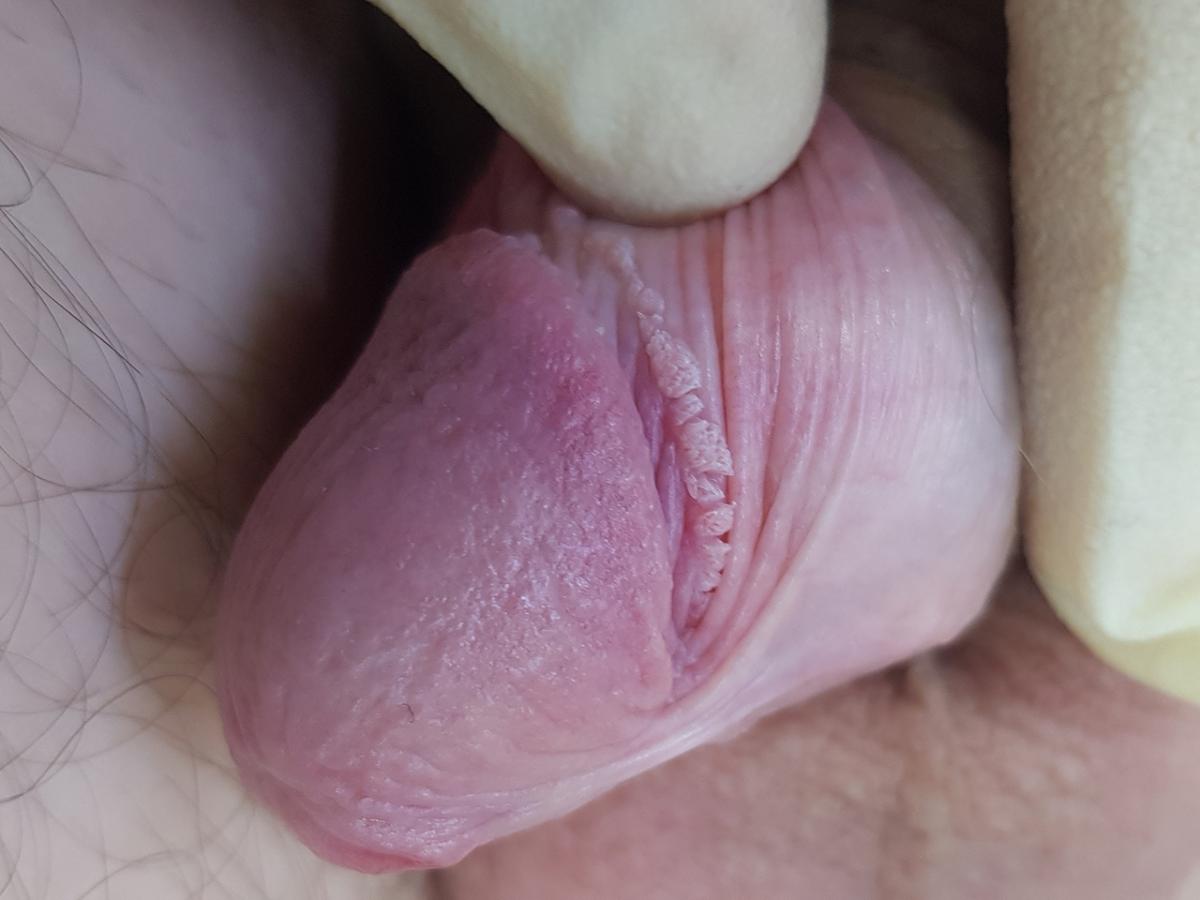 Симтомы инфекции