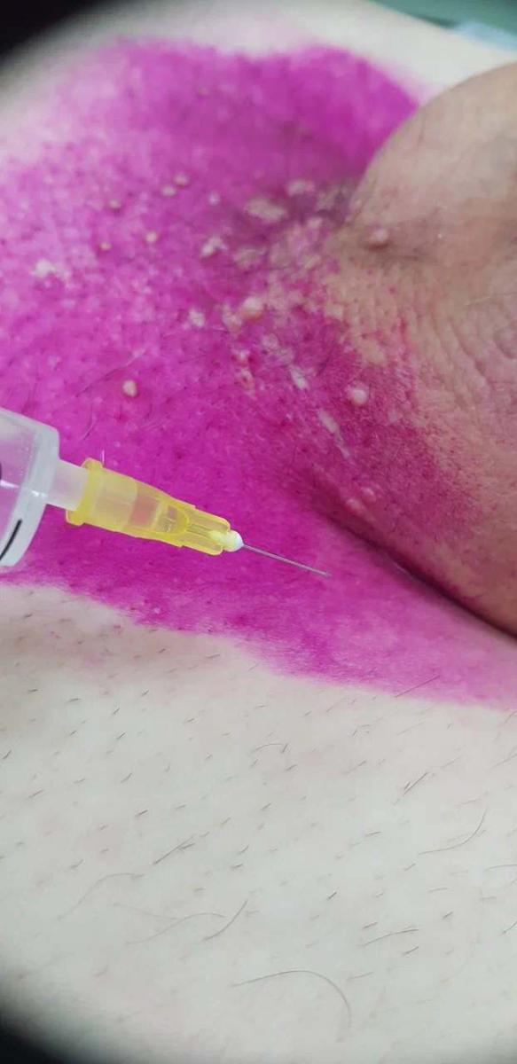 Лимфотропное введение