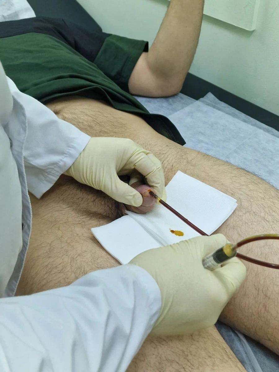 Инстилляции уретры