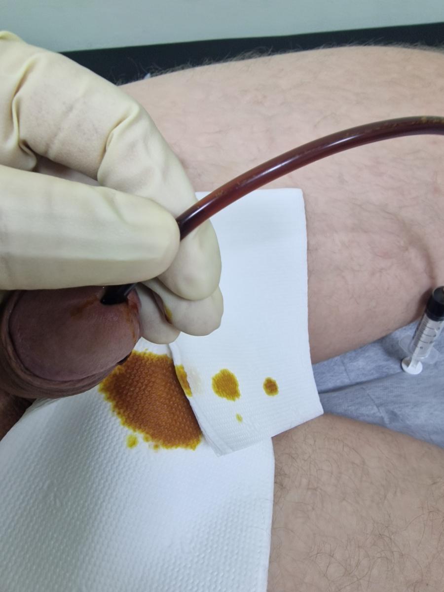 инстилляция в уретру инстилляция