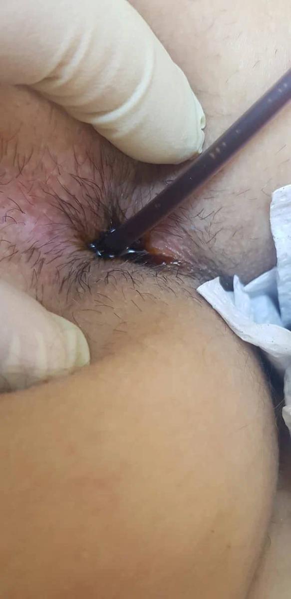 инсталляция ануса