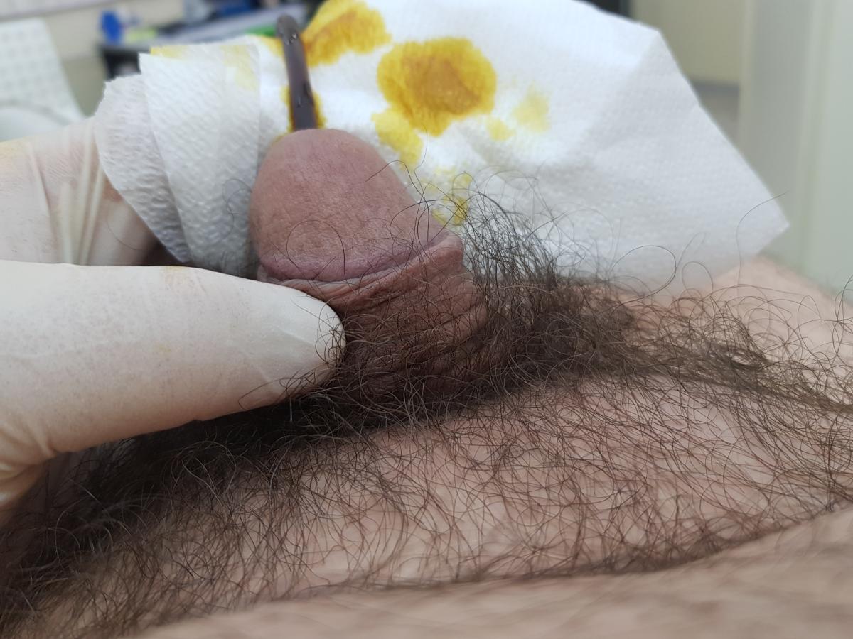 инстилляция 