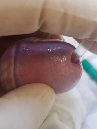 инстилляция в уретру