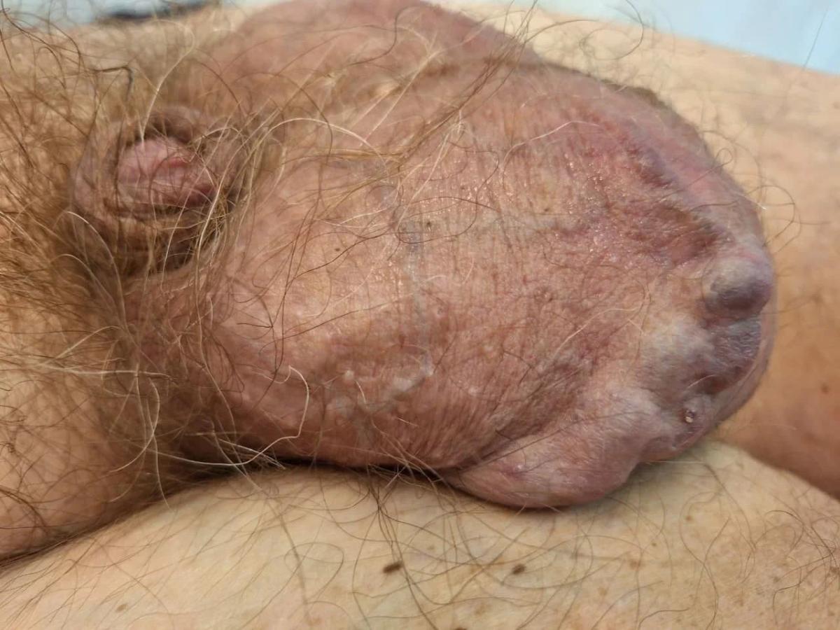 интратестикулярное варикоцелле 