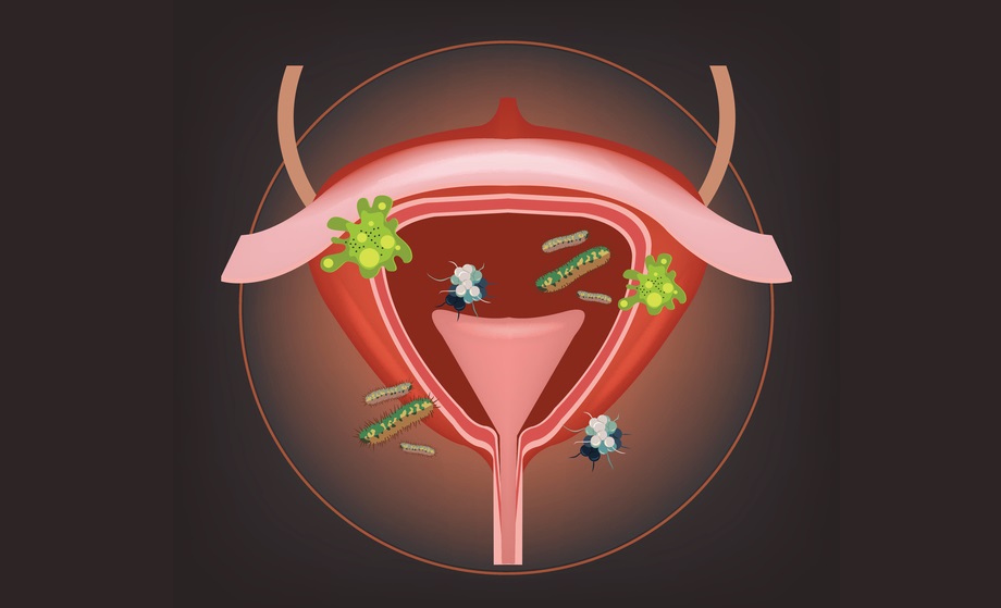 бактерии как причина резей и жжения при мочеиспускании у женщин