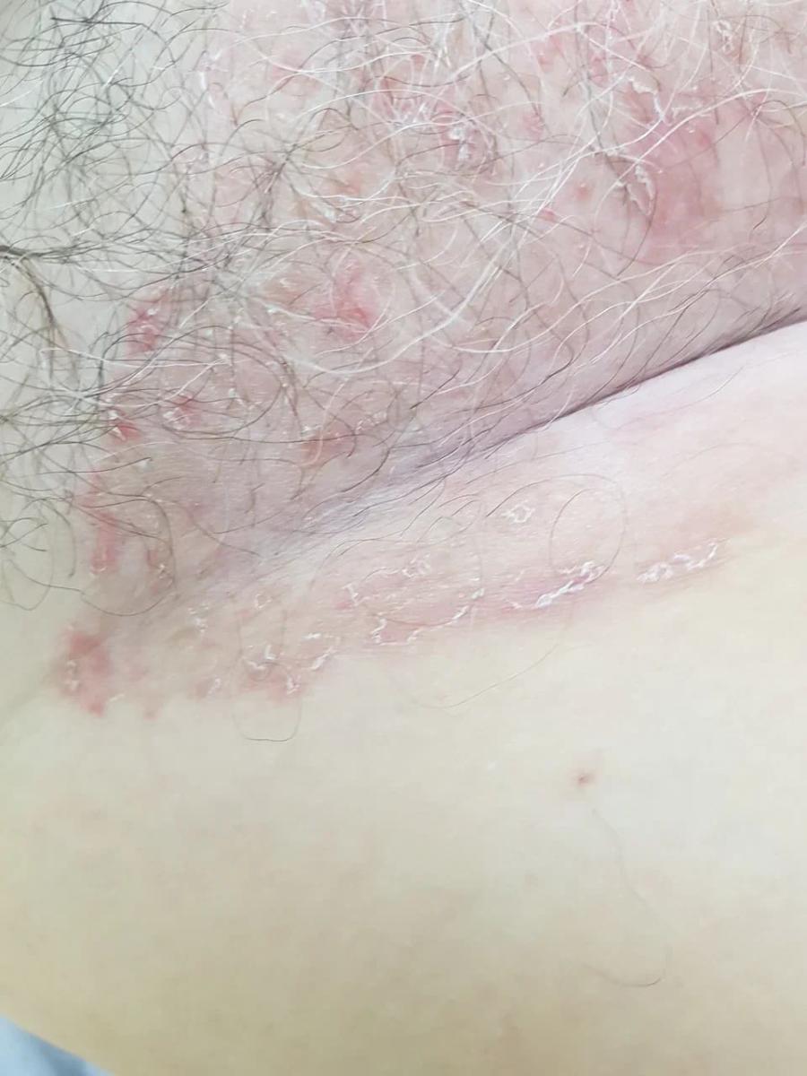 изолированный псориаз в паховой складке