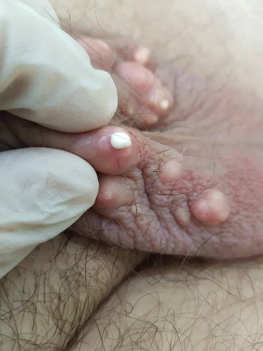 Кальзиноз мошонки Кальциноз мошонки