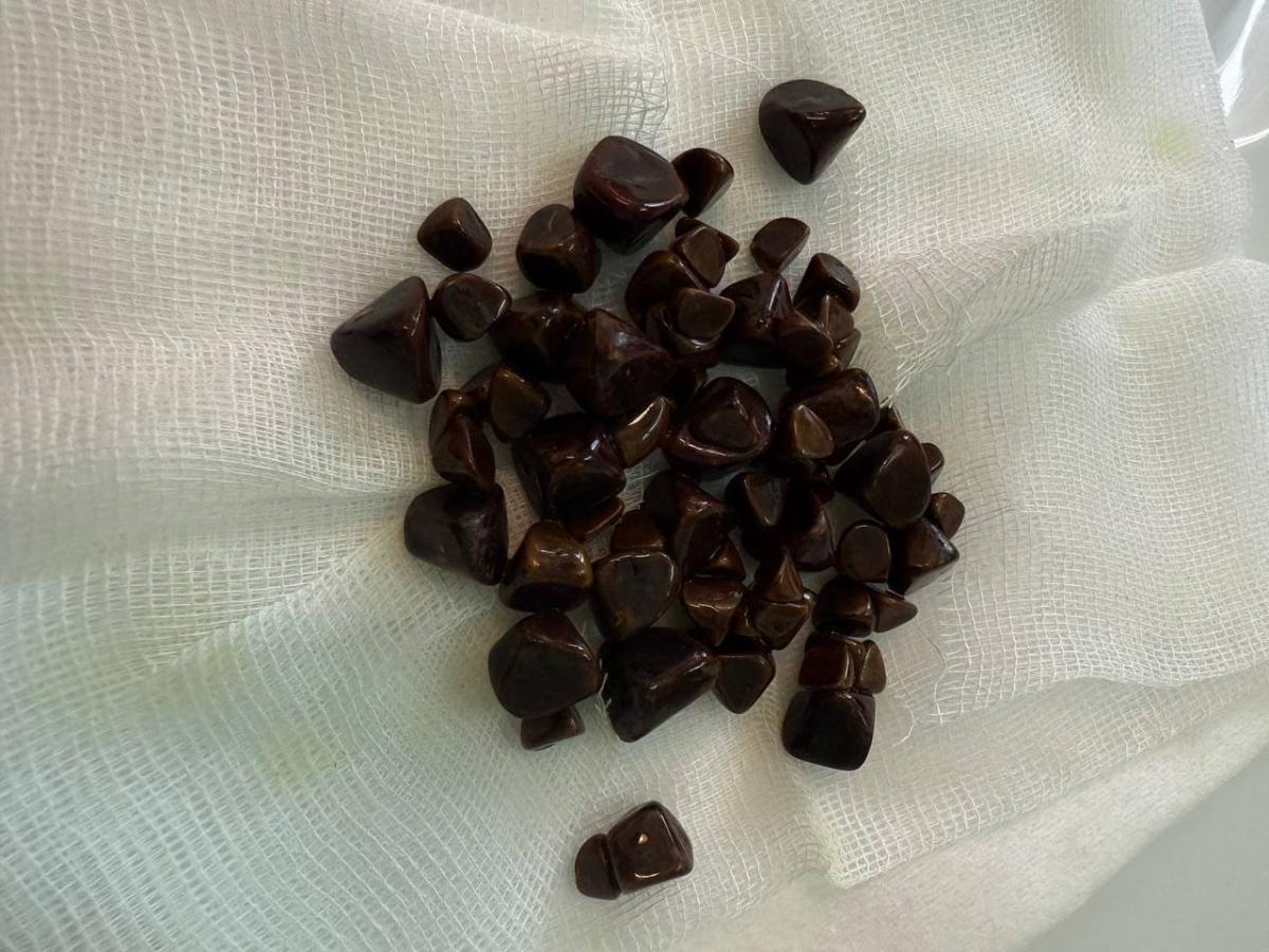 Камни из уретры