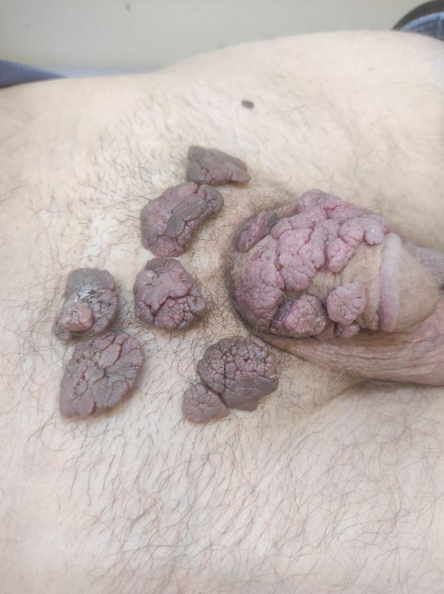 Многочисленные папилломы на половом члене