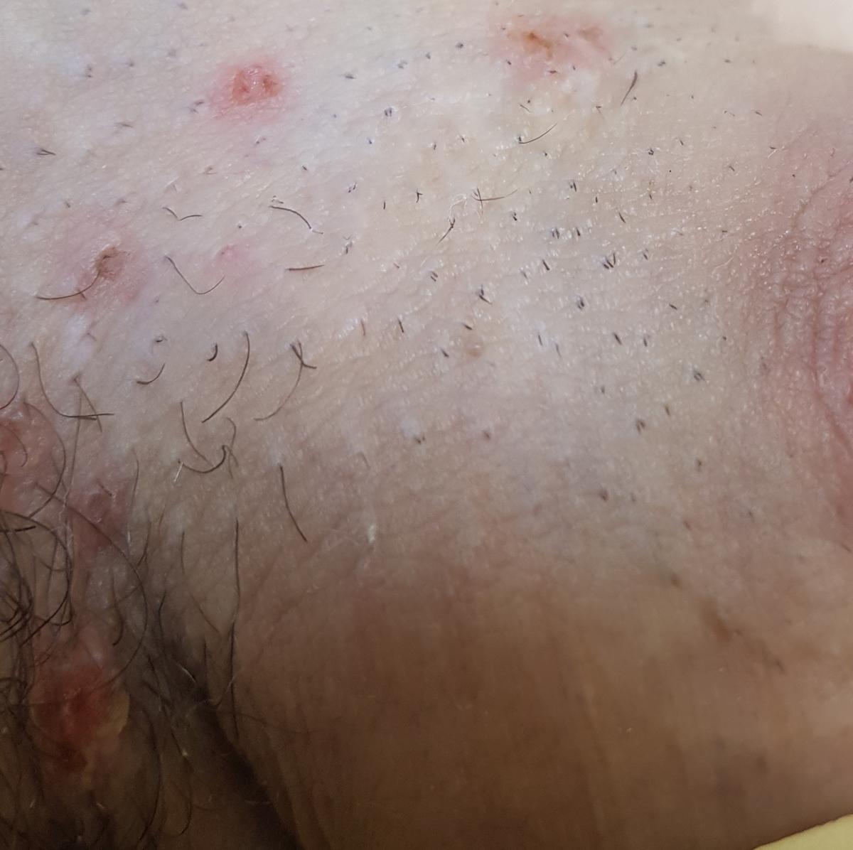 После удаления кондилом