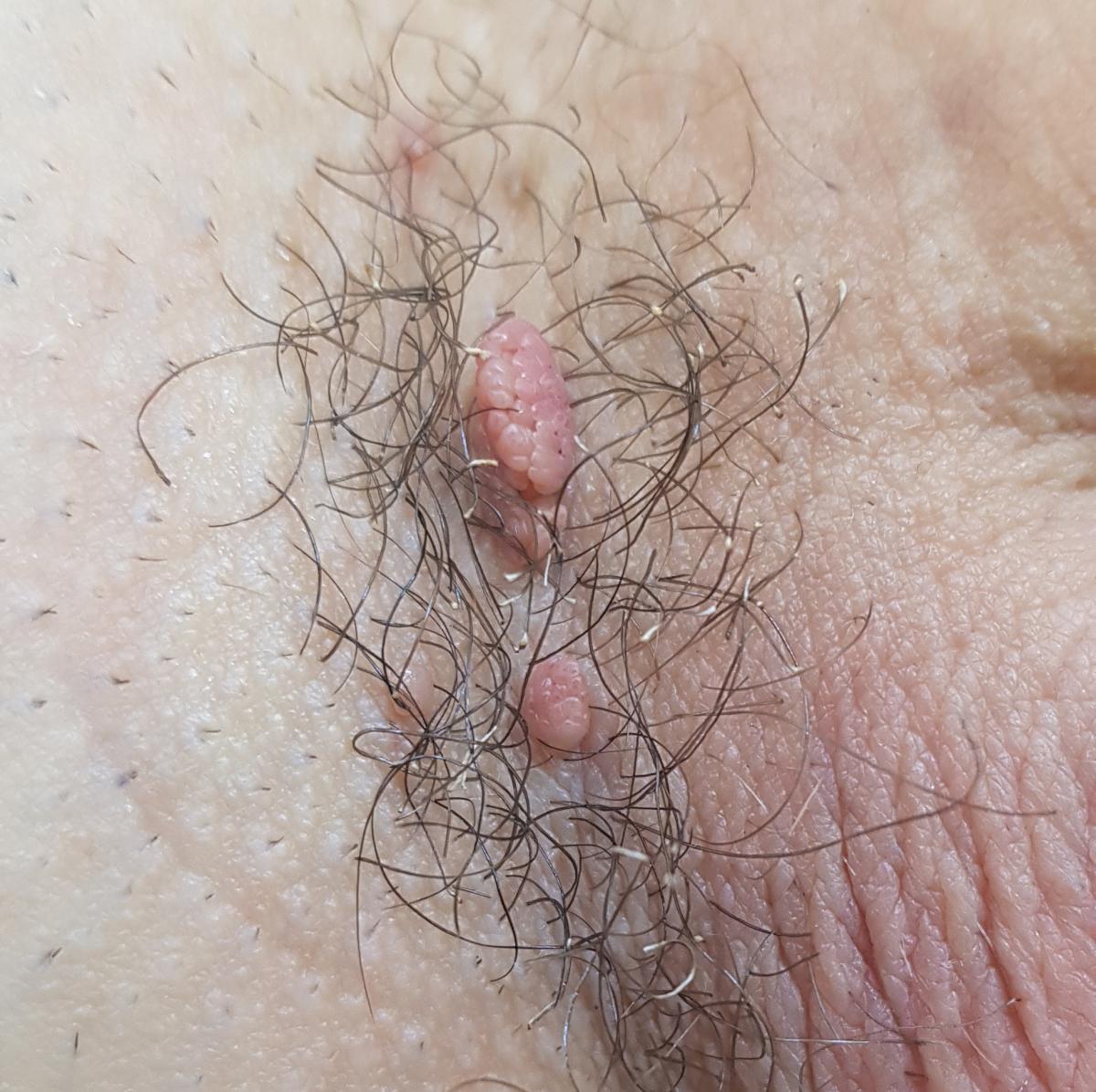 Кондиломы до удаления