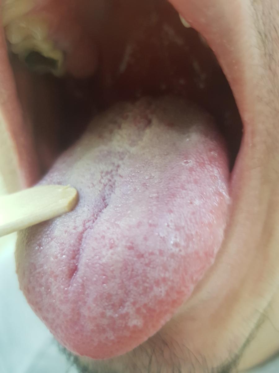 Белый налет во рту от кандиды глабрата Белый налет во рту