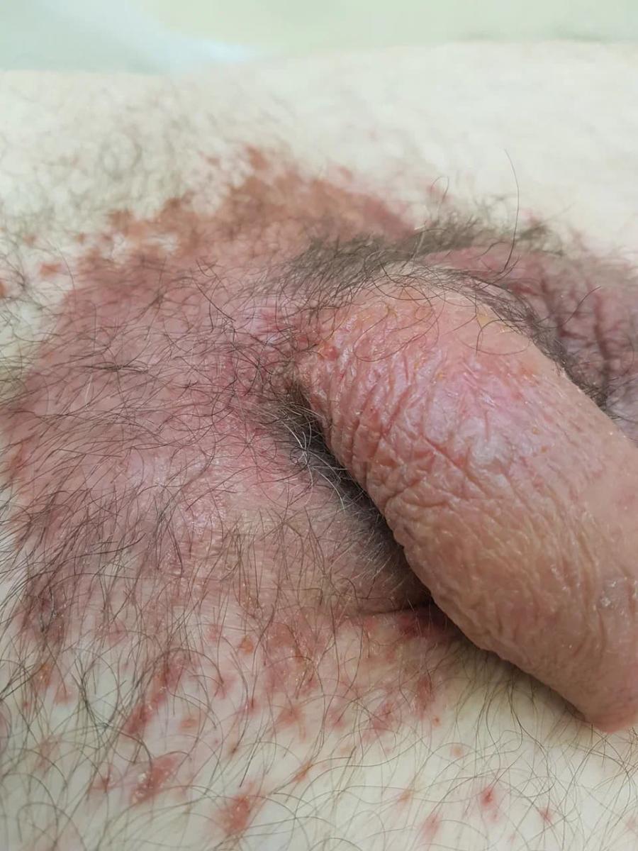 кандидоз кандидоз