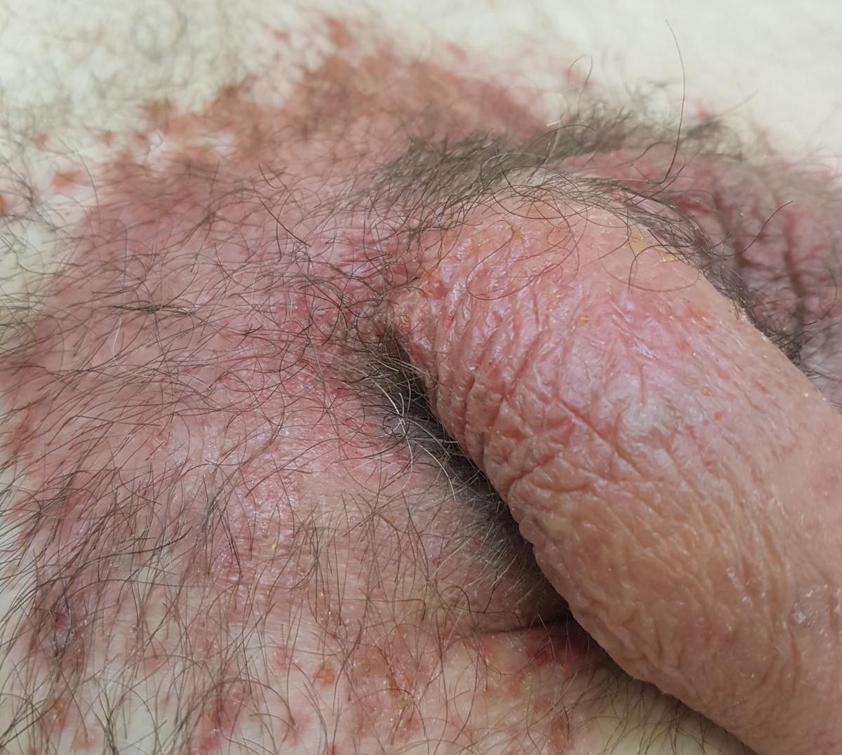 кандидоз лобка кандидоз лобка