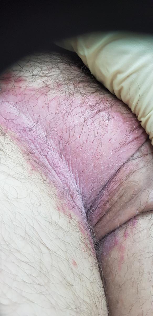 кандидоз паховых складок у мужчин