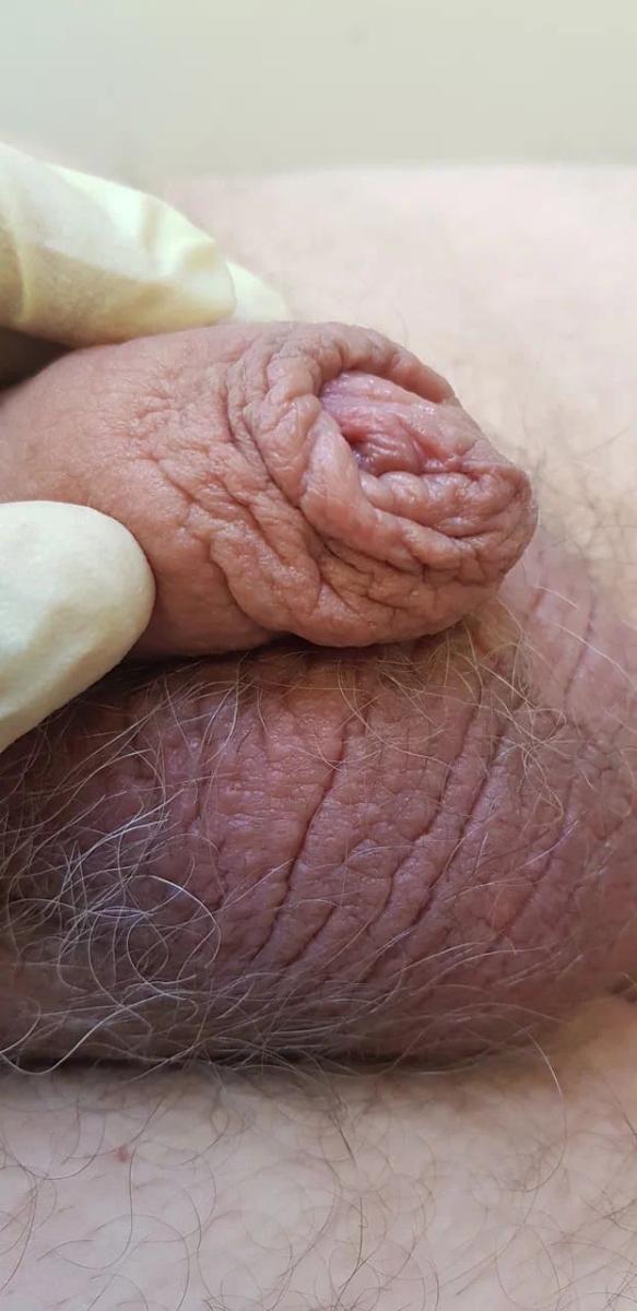 Отечность полового органа