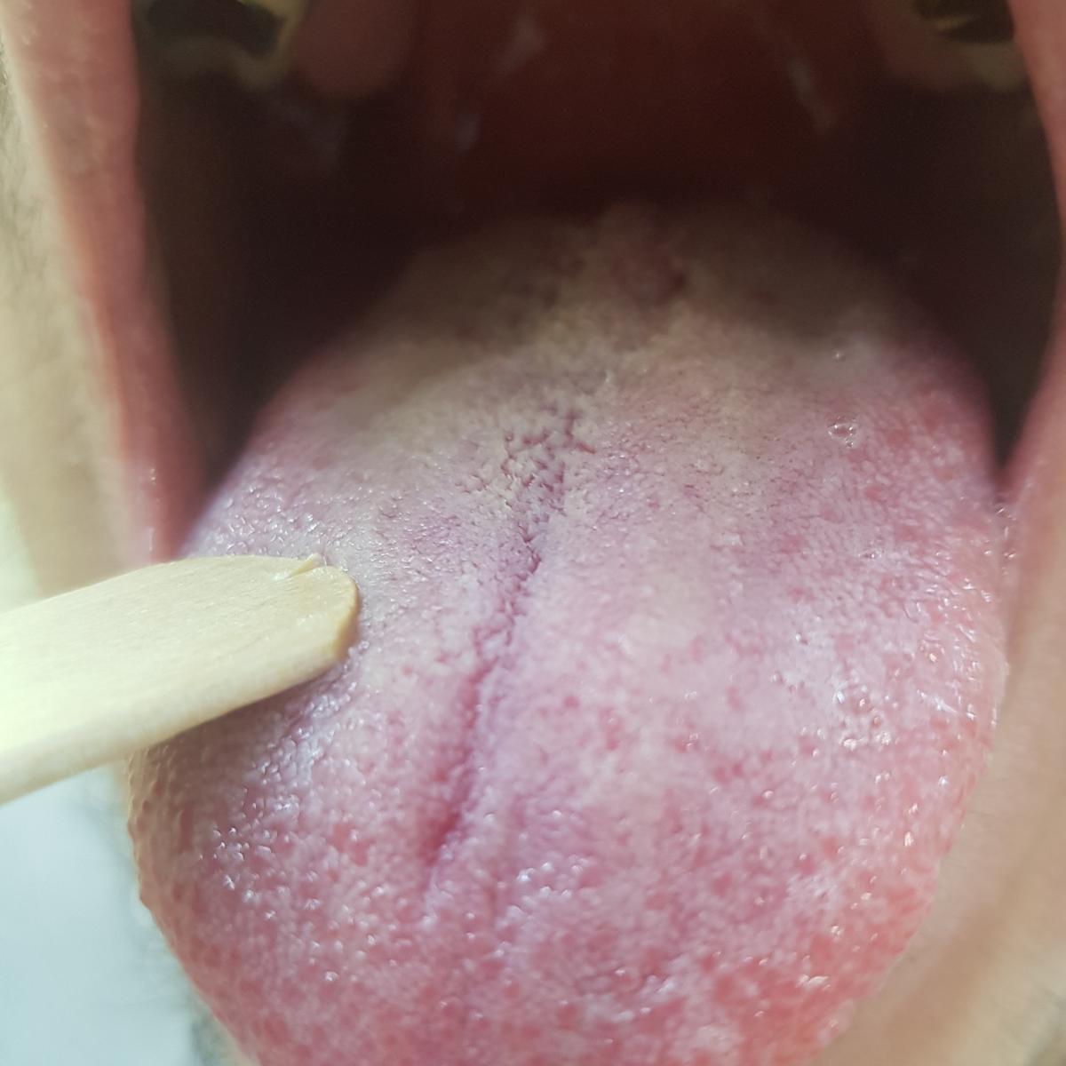 молочница во рту кандидоз полости рта