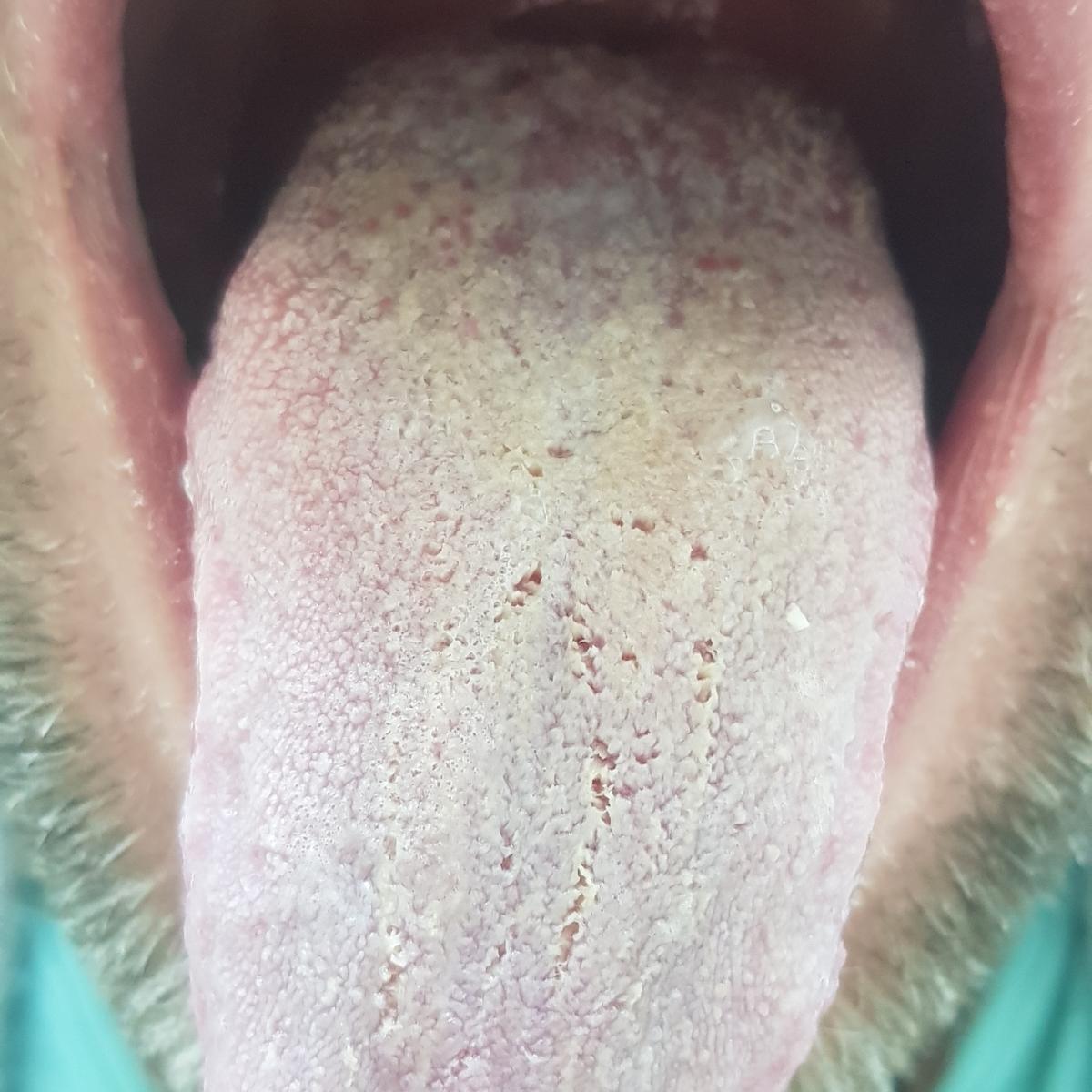 Кандидоз симптомы Кандидоз симптомы на языке