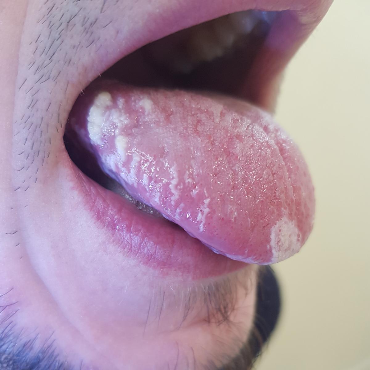 Кандидоз симптомы при ВИЧ Кандидоз при ВИЧ