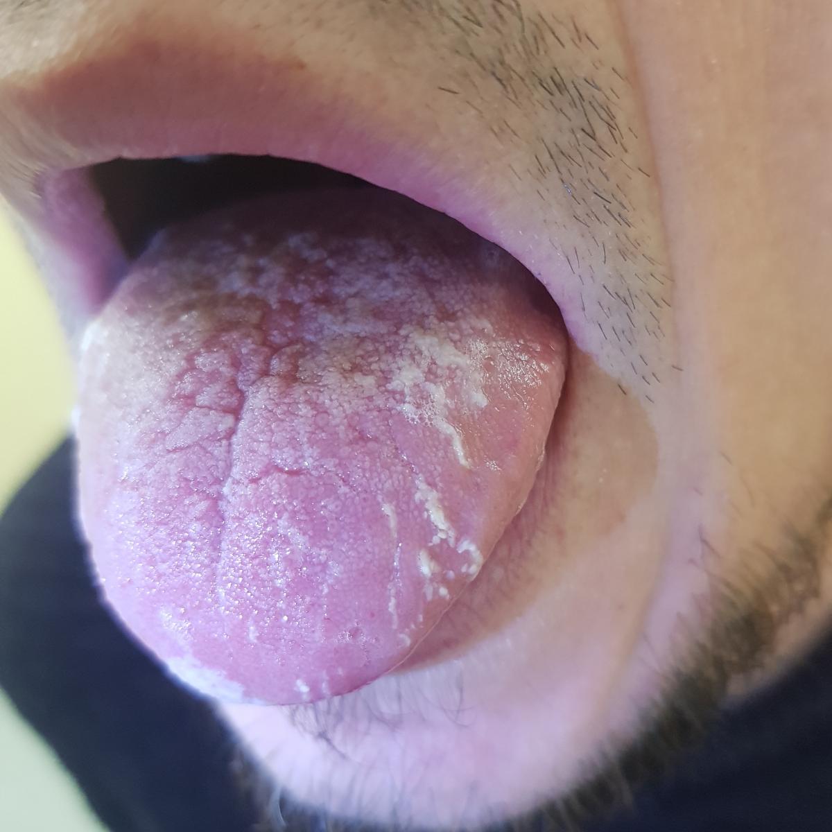 кандидоза и ВИЧ Кандидоз на языке при ВИЧ