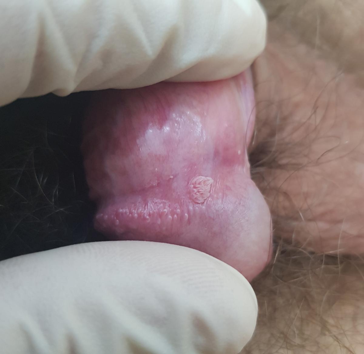 Кондиломы на венечной борозде