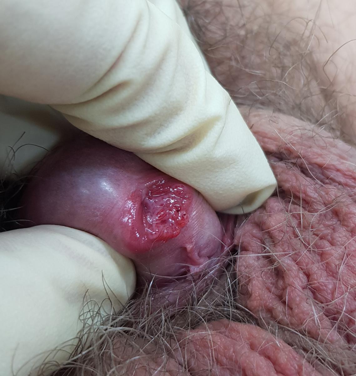 Симтомы в уретре