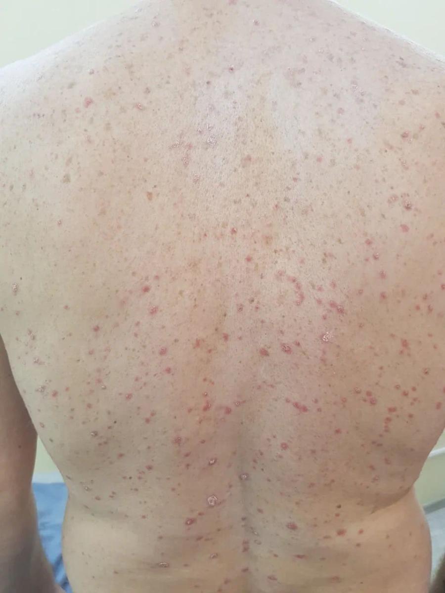 каплевидный псориаз