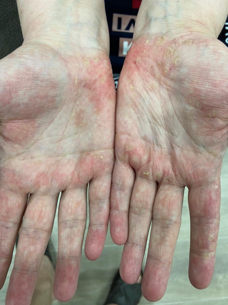 кератодермия