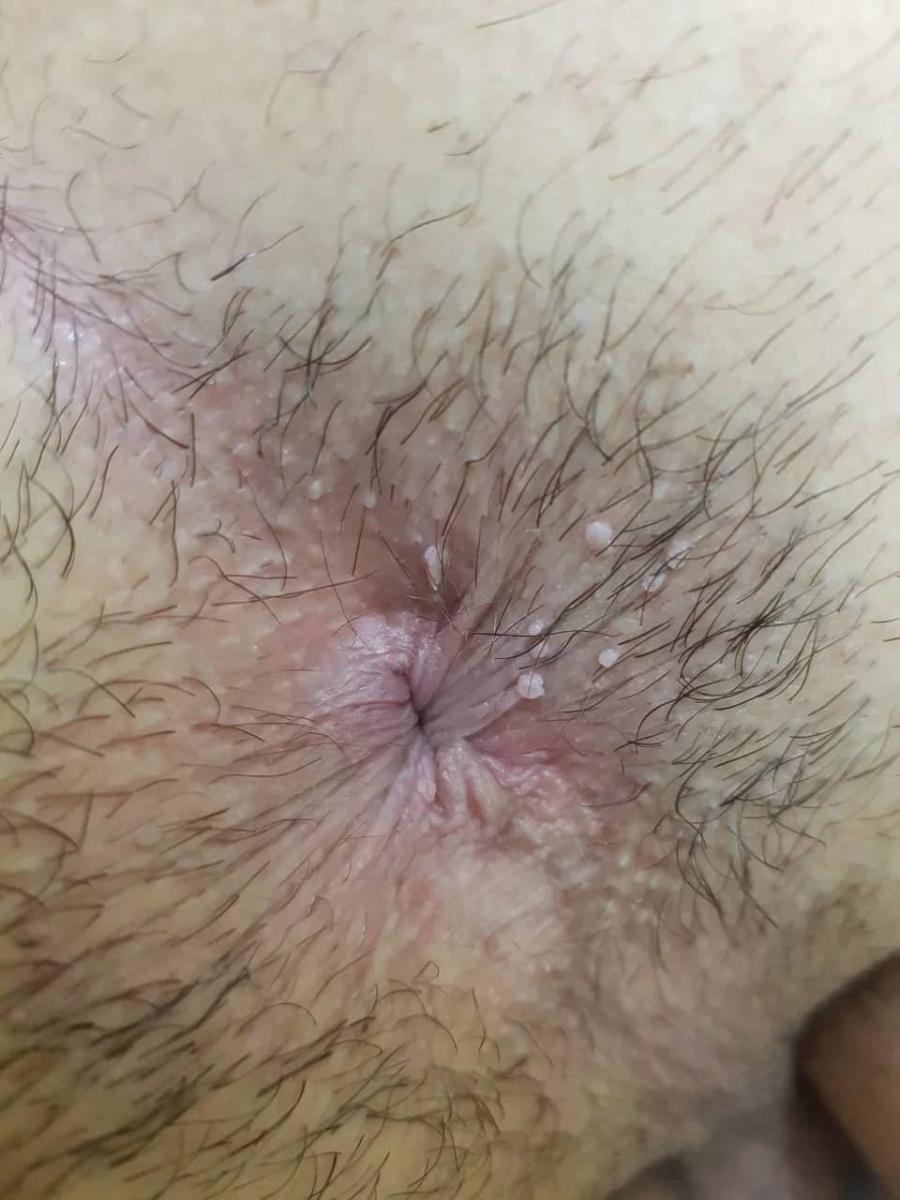 Кондиломы ануса