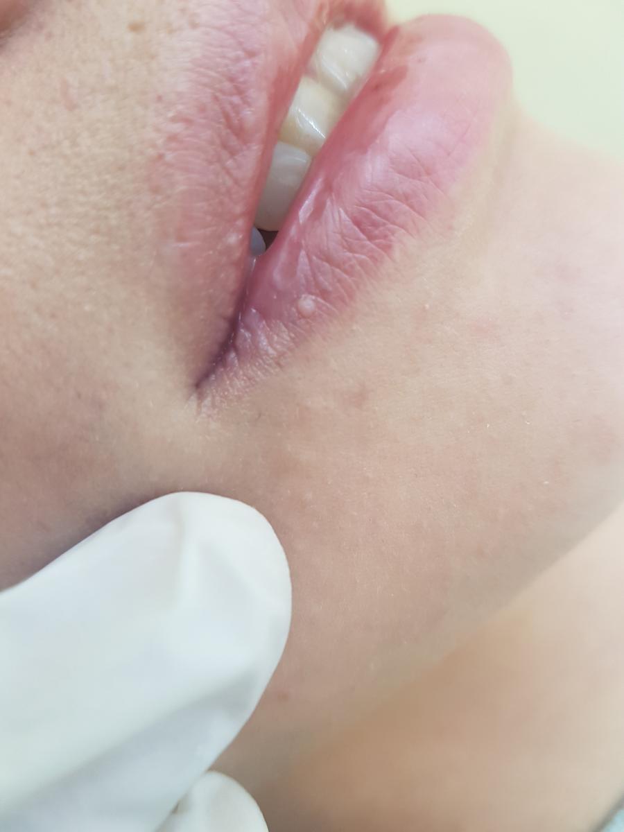 впч при оральном сексе впч