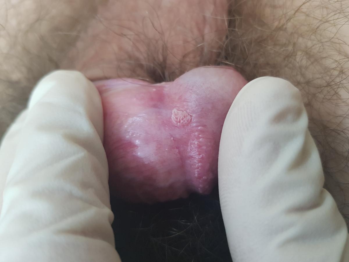 Вирус папилломы человека