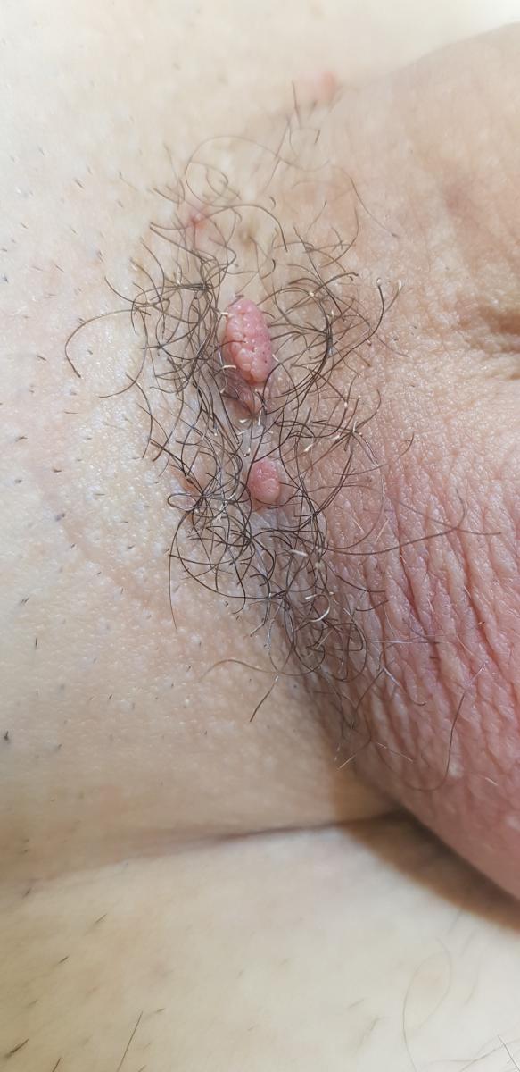 интимная жизнь секс при ВПЧ