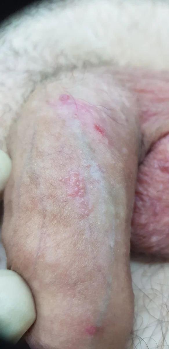 удаление кандилом