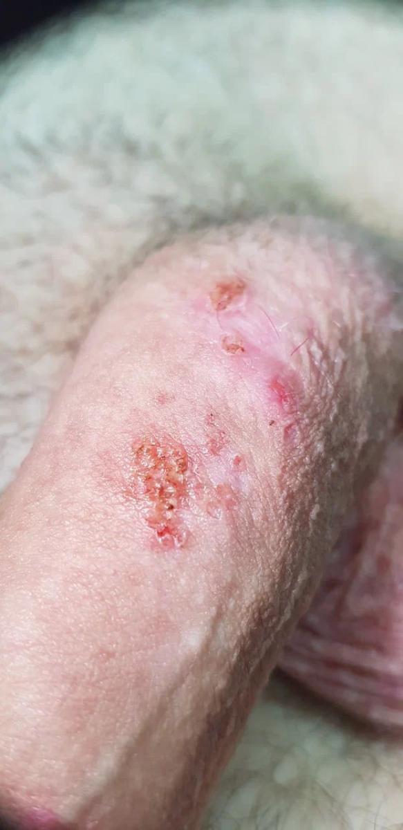 удаление кандилом