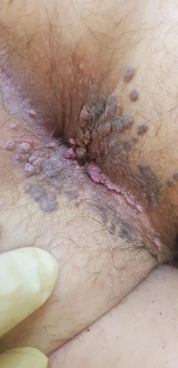 Кондиломы ануса