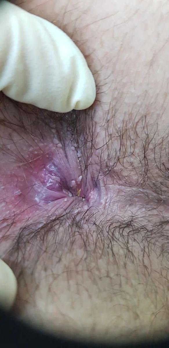 Кондиломы ануса