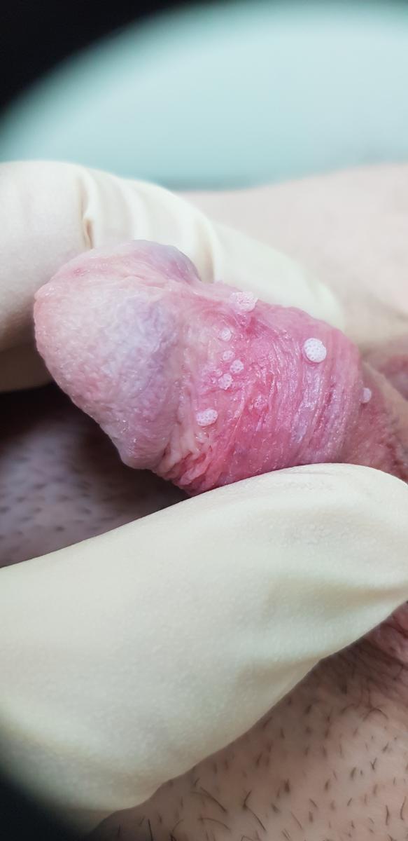 впч-кондиломы крайней плоти и уретры