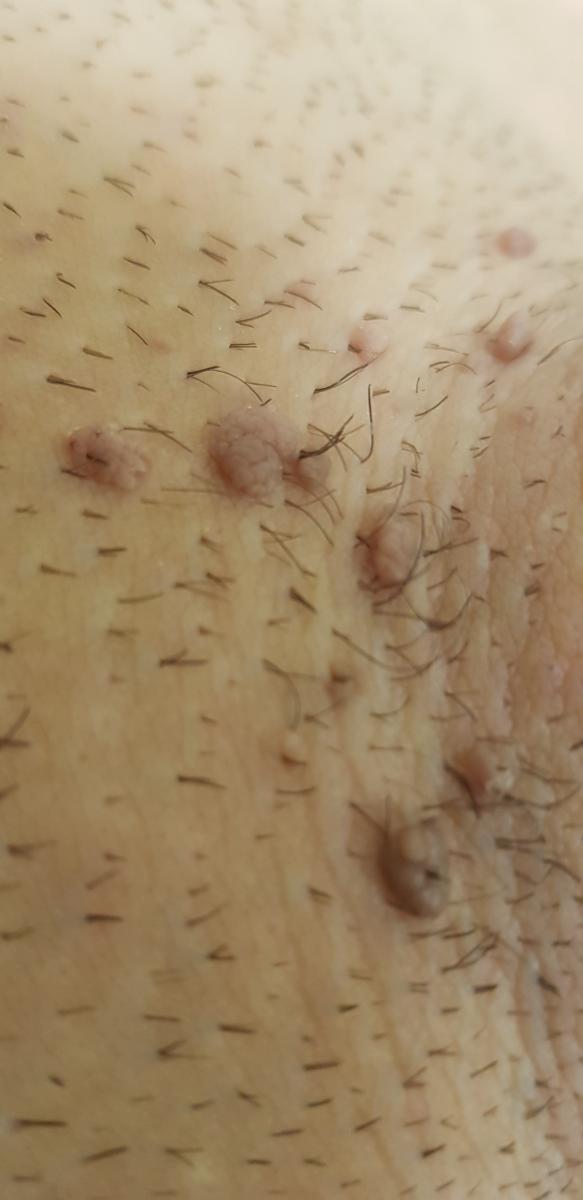 Темные бородавки 