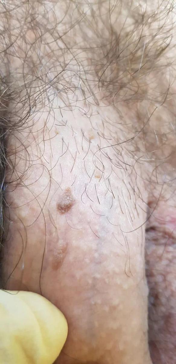 удаление кандилом