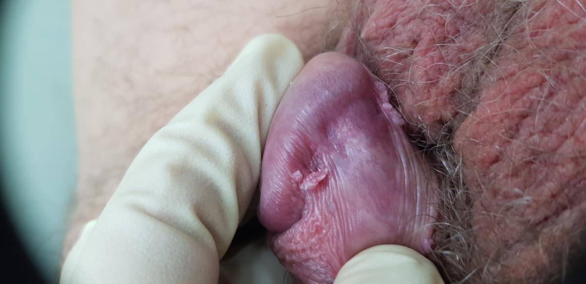 Остроконечные кондиломы на головке полового члена